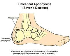 My child has heel pain could it be plantar fasciitis?